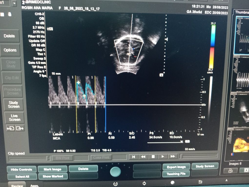 Ecograf Doppler color Siemens