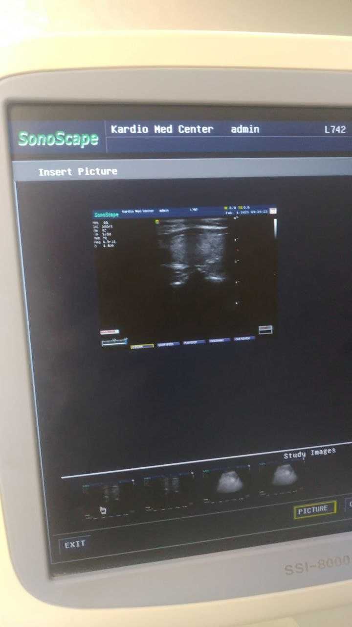 УЗИ аппарат стационар. SonoScape SSI - 8000