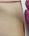Epilare definitiva laser Bucuresti Sector 3 (zona trapezului)