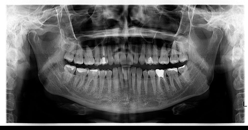 Ortopantomograf Soredex Cranex Novus aparat radiologie dentara
