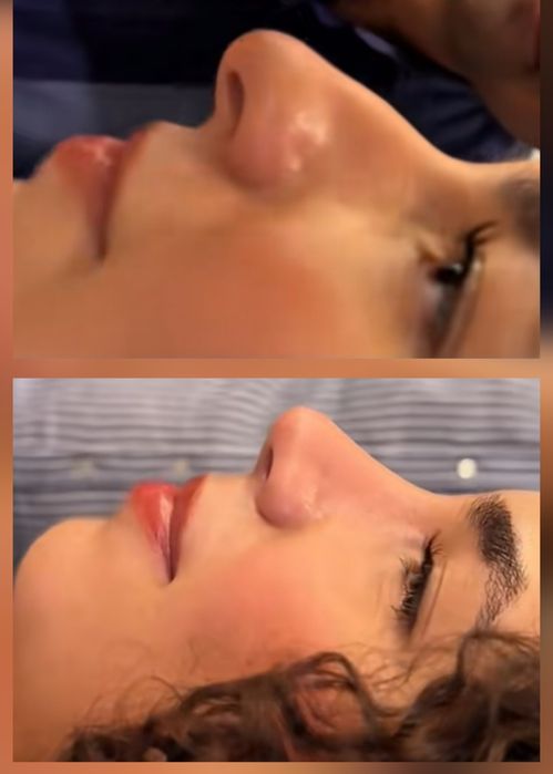 Rinoplastie, mărire buze, micropigmentare