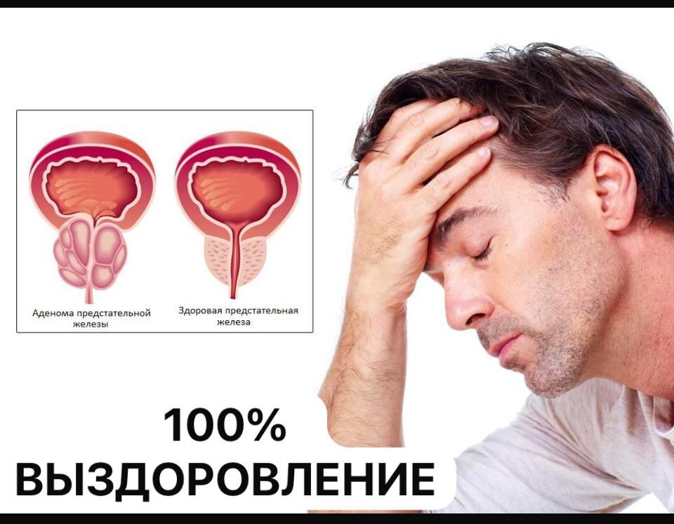 100% выздоровление от аденомы простаты .