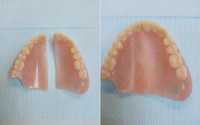 Починка зубных протезов