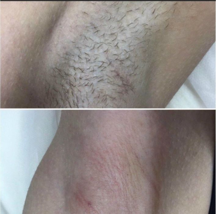 Депиляция мужская и женская