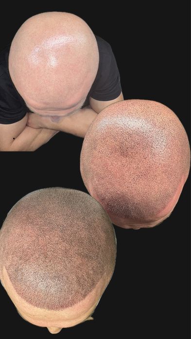 Micropigmentare Scalp și barba Bucuresti SMP chelie implant transplant