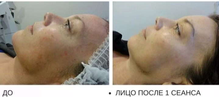 Ультразв. чистка, фарфоровая кукла, rf-лифтинг 5т.тг