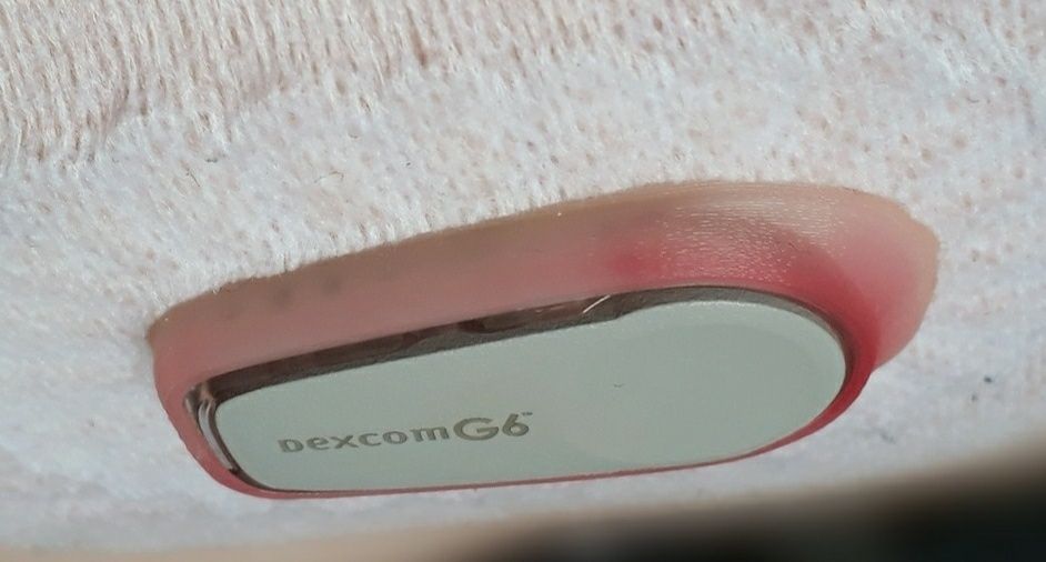 Dexcom G6./По добре прикрепване/