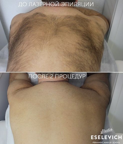 Депиляция для мужчин и женщин