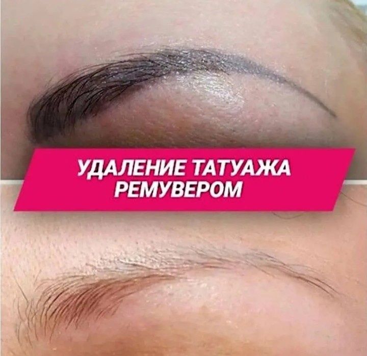 Удаление татуажа