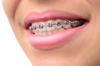 Aparate dentare ortodontice 500lei/arcada. Consultatie gratuita