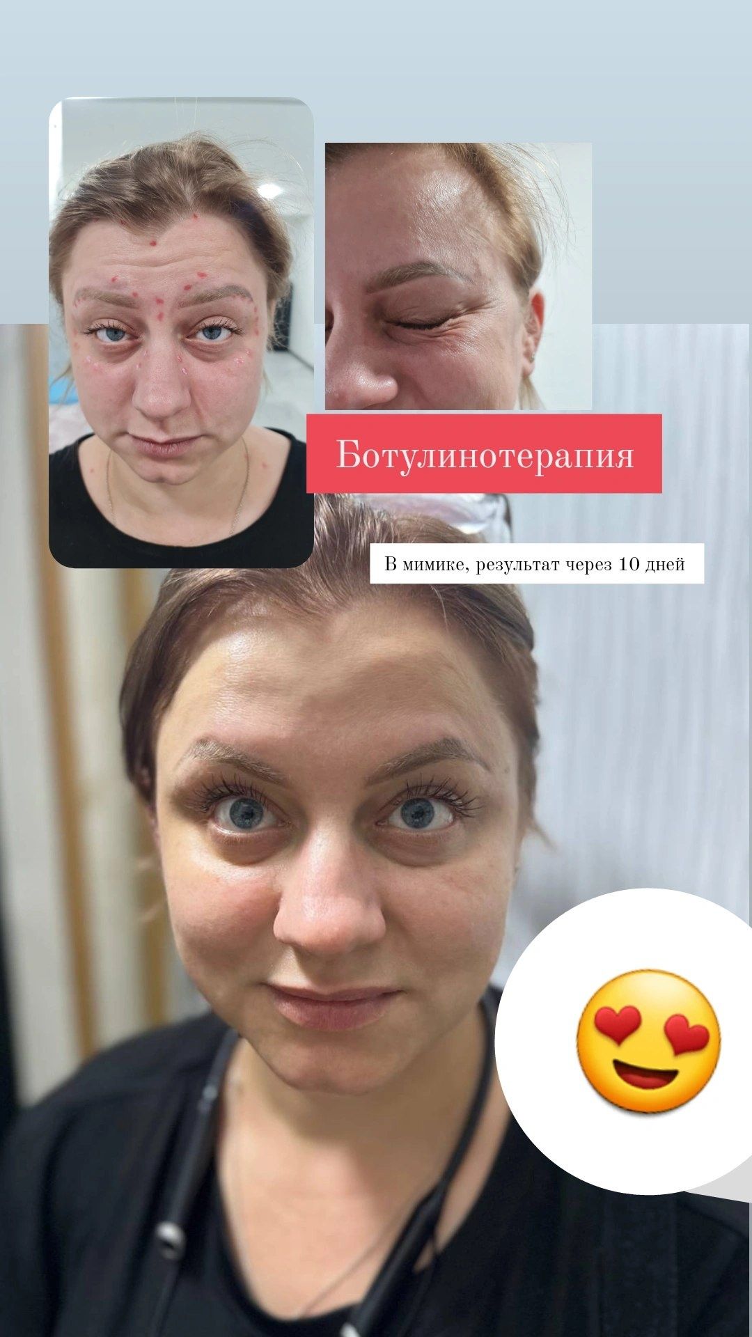 Ботокс фулл фейз, тепа  учли кисм, гипергидроз, губы, филлеры