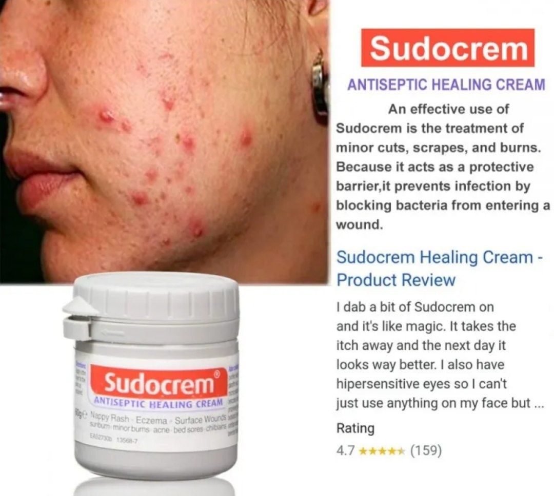 Sudocrem бу крем хар хил тошмалар,кизариш,яра,мозоль,угри,аллергия ун.