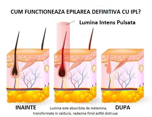 Epilare definitiva