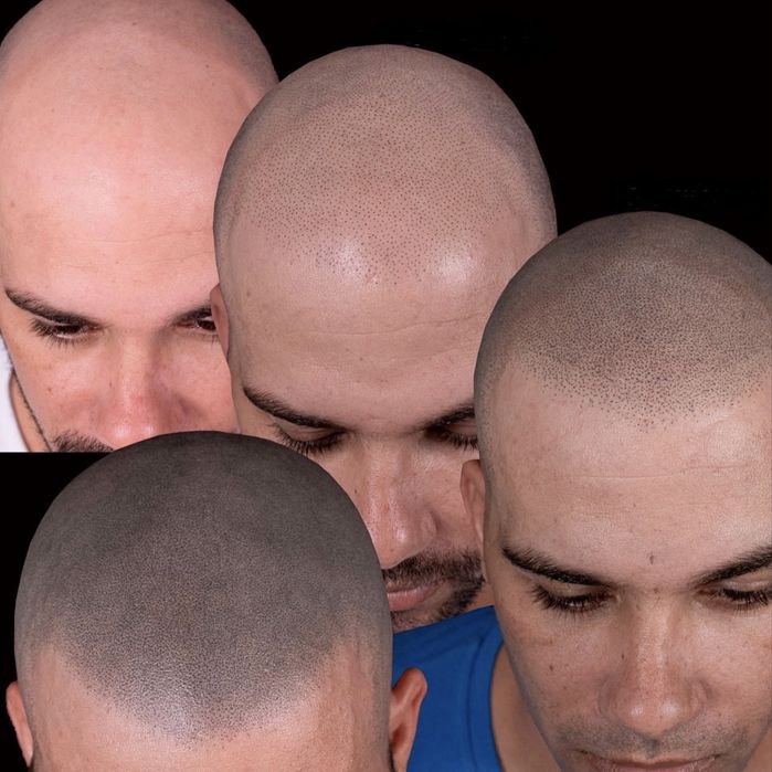 Micropigmentare Scalp și barba Bucuresti SMP chelie implant transplant