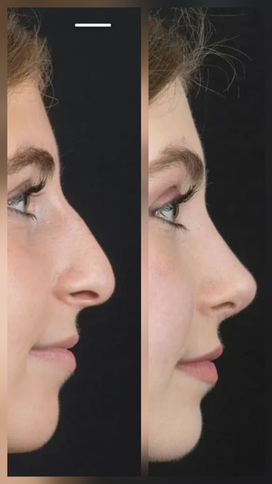 Remodelare nas și buze