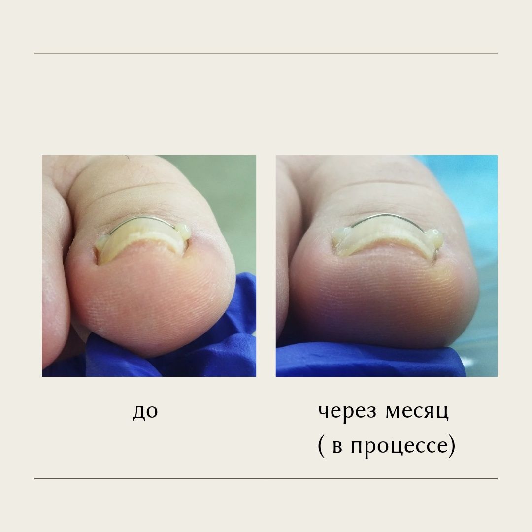 Педикюр, подолог