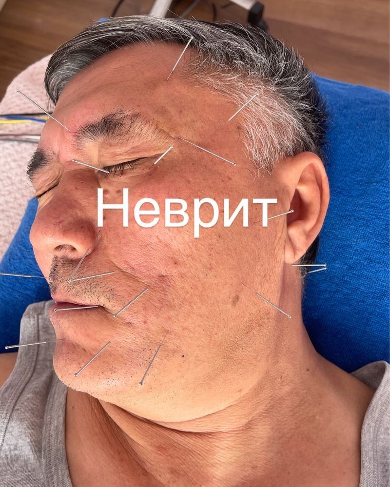 Иглотерапия рефлескотерапия точечный