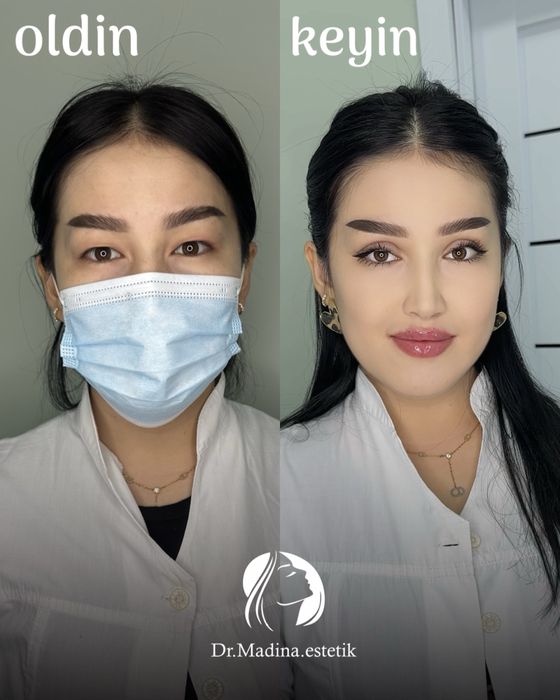 50% chegirmada blefaroplastika