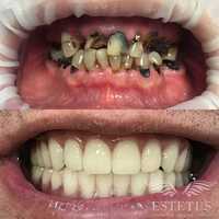 стоматология наращивание зубы.и зубные протезы