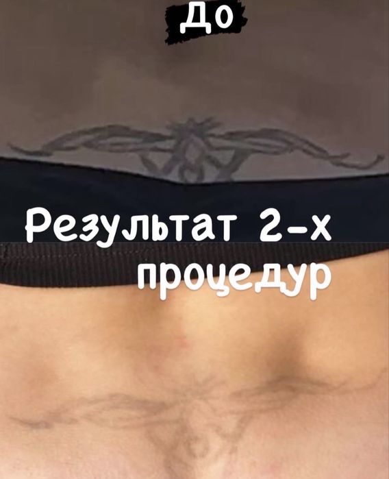 Удаление татуаж за 2 процедуры безболезненно