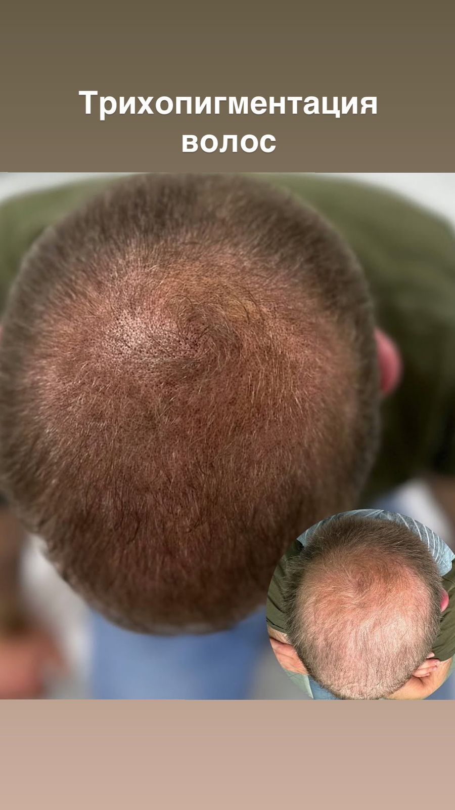 Трихопедментация головы