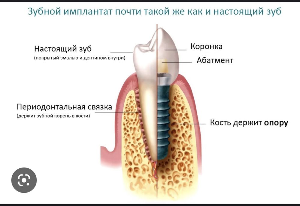 Акция на имплантацию зубов