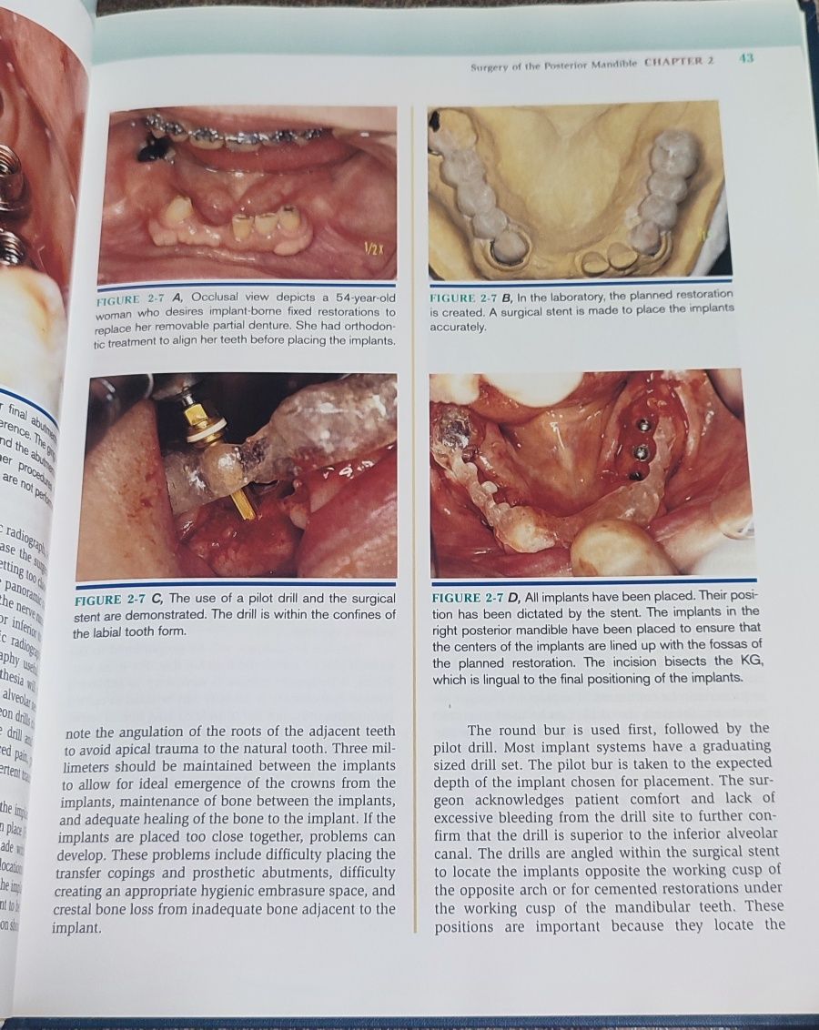 Atlas stomatologic Dental Implant Surgery