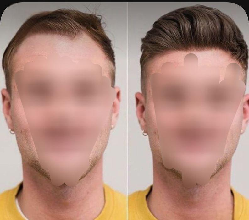 Мъжки системи от естествена коса Промоция от 650лв