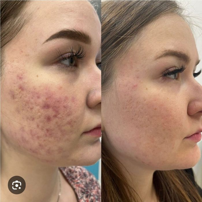 Угри,акне.прыши личение.