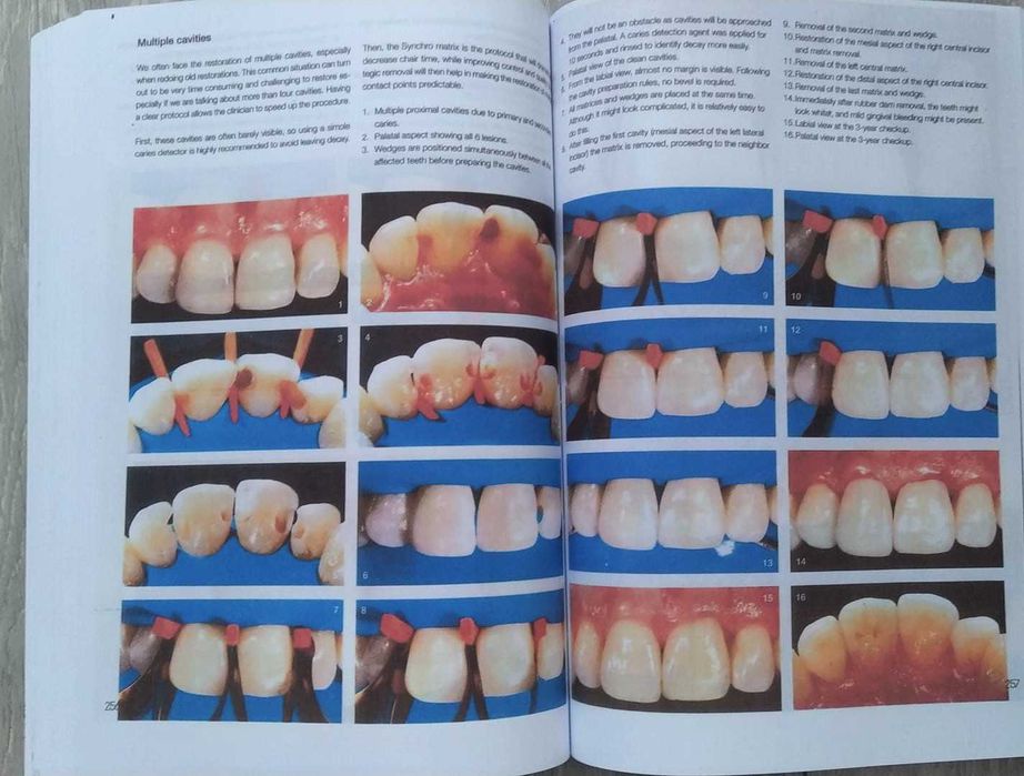 Layers 2 Direct Composites: The Styleitaliano Clinical Secrets - 2022