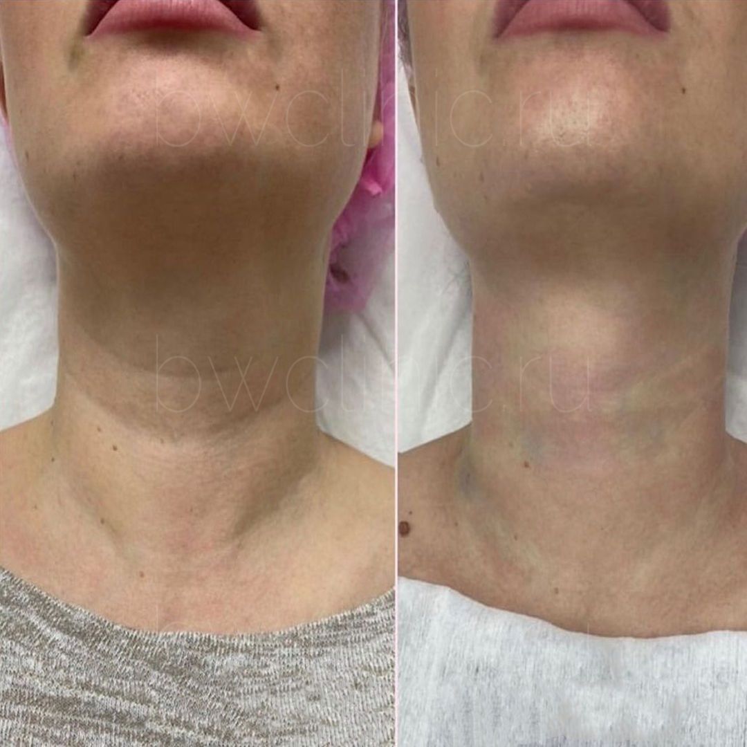 Акция Ботокс лица по 30$