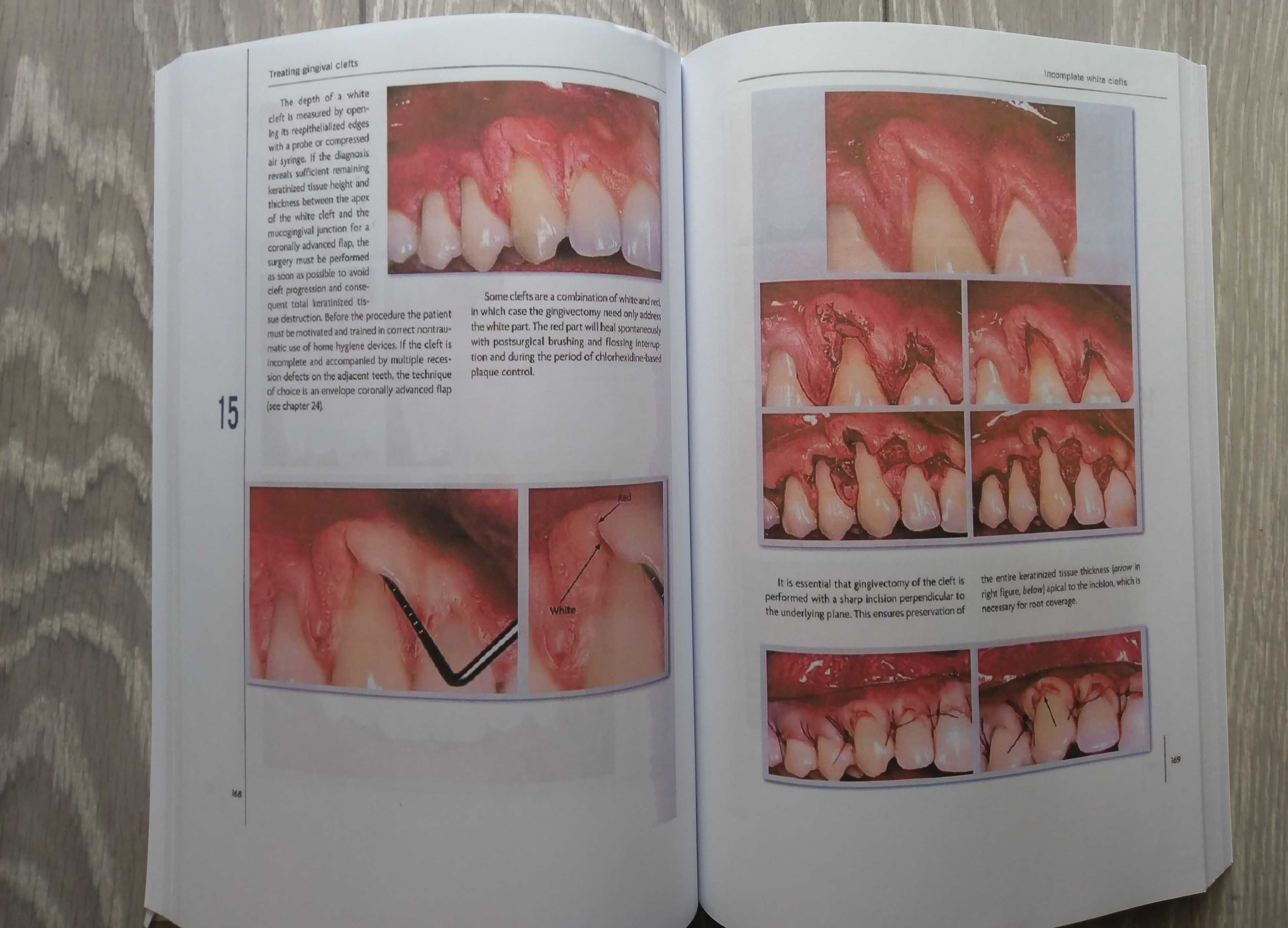 Mucogingival Esthetic Surgery - Giovanni Zucchelli - 1 Edition 2012