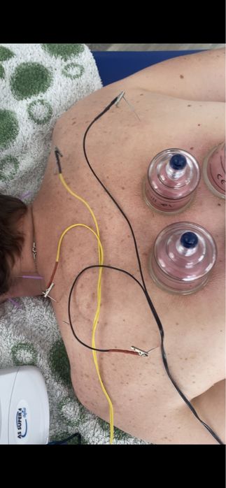 Recuperare Neurologică, Chiropractica,Acupunctură, Cupping( Ventuze)