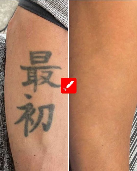 Лазерно Премахване на Татуировки