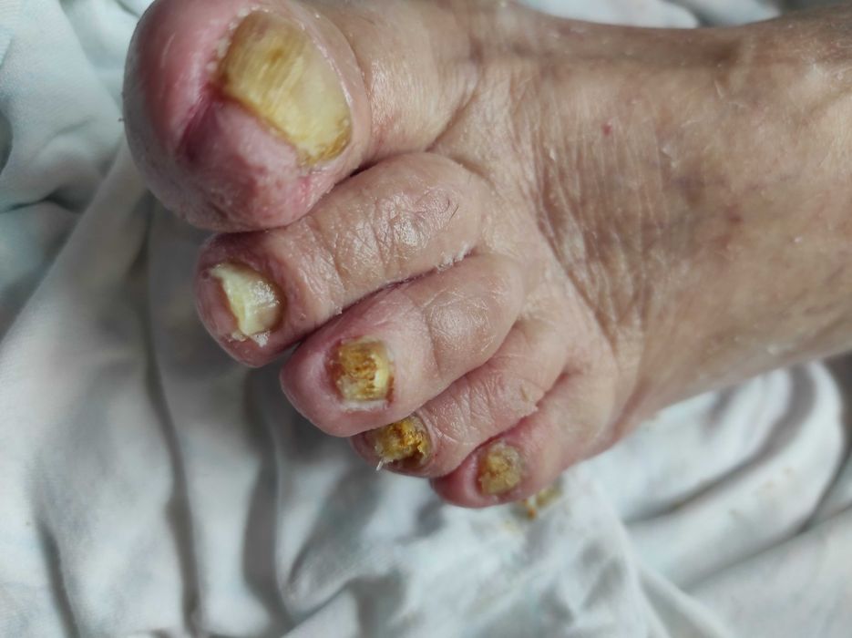 Медицински педикюр по домовете