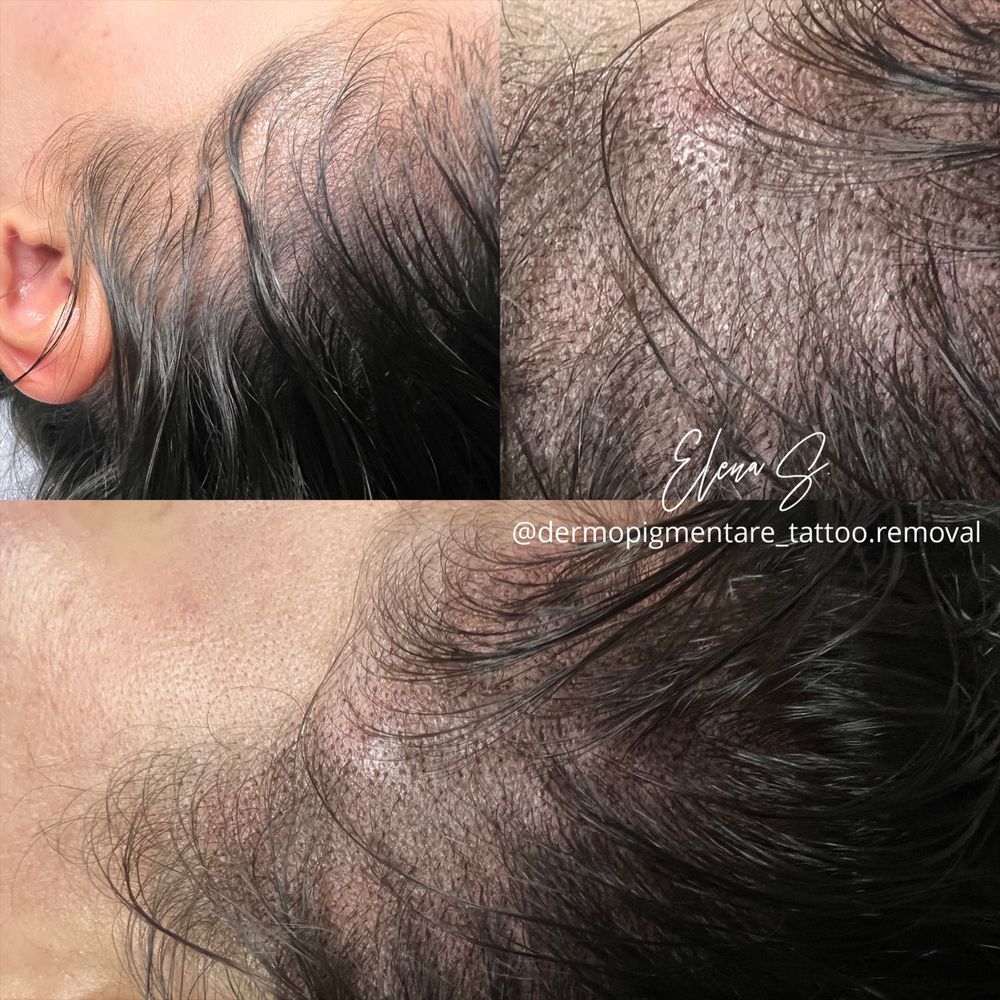 Micropigmentare scalp tricopigmentare efect indesire par alopecie