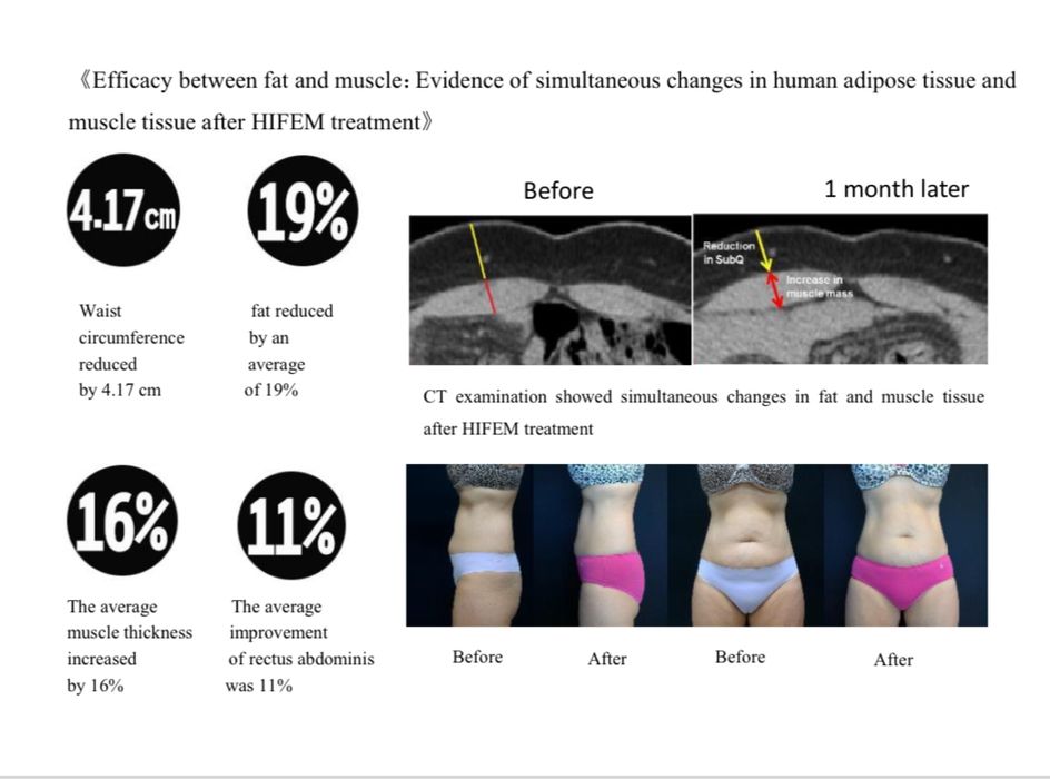 Апарат за мускулна стимулация