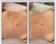 Masaj limfatic post operator abdominoplastie