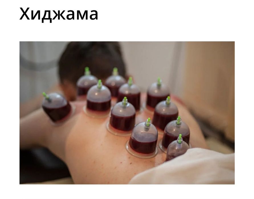 Хиджама капилляро терапия