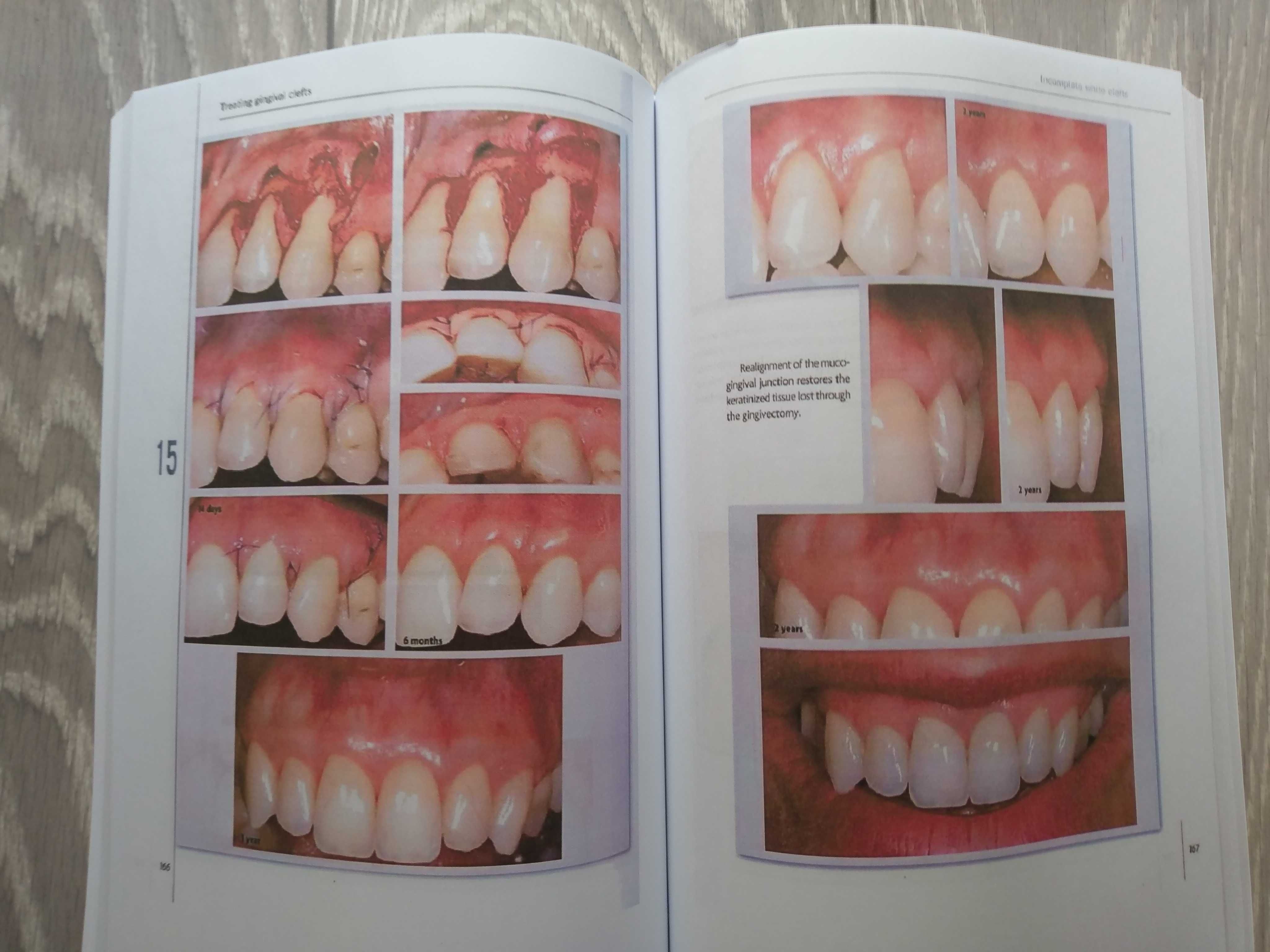 Mucogingival Esthetic Surgery - Giovanni Zucchelli - 1 Edition 2012