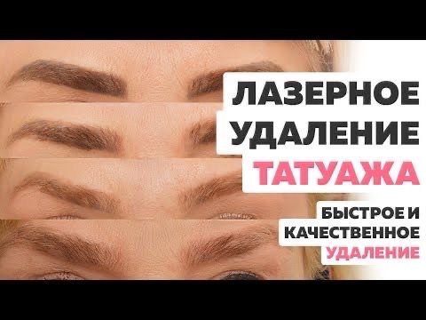 Лазерная эпиляция