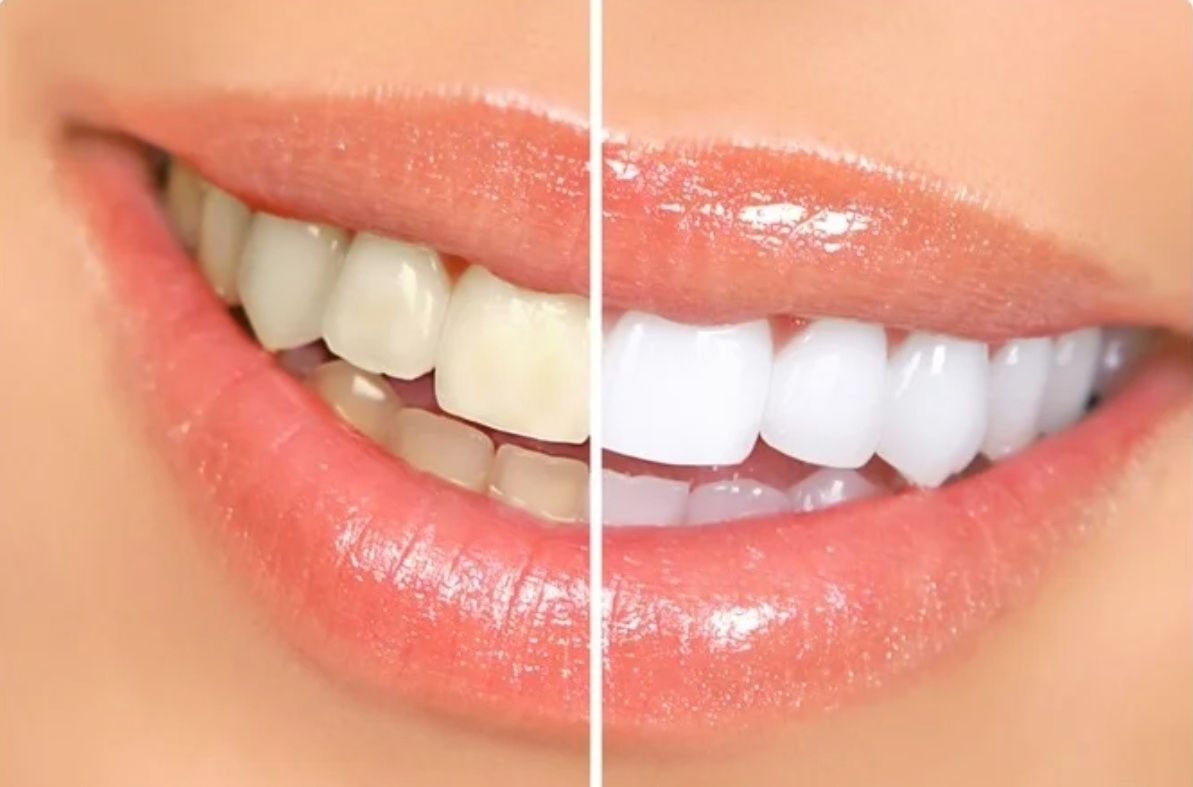 Домашна избелваща система B-Shine. Бели зъби само за 15 минути на ден