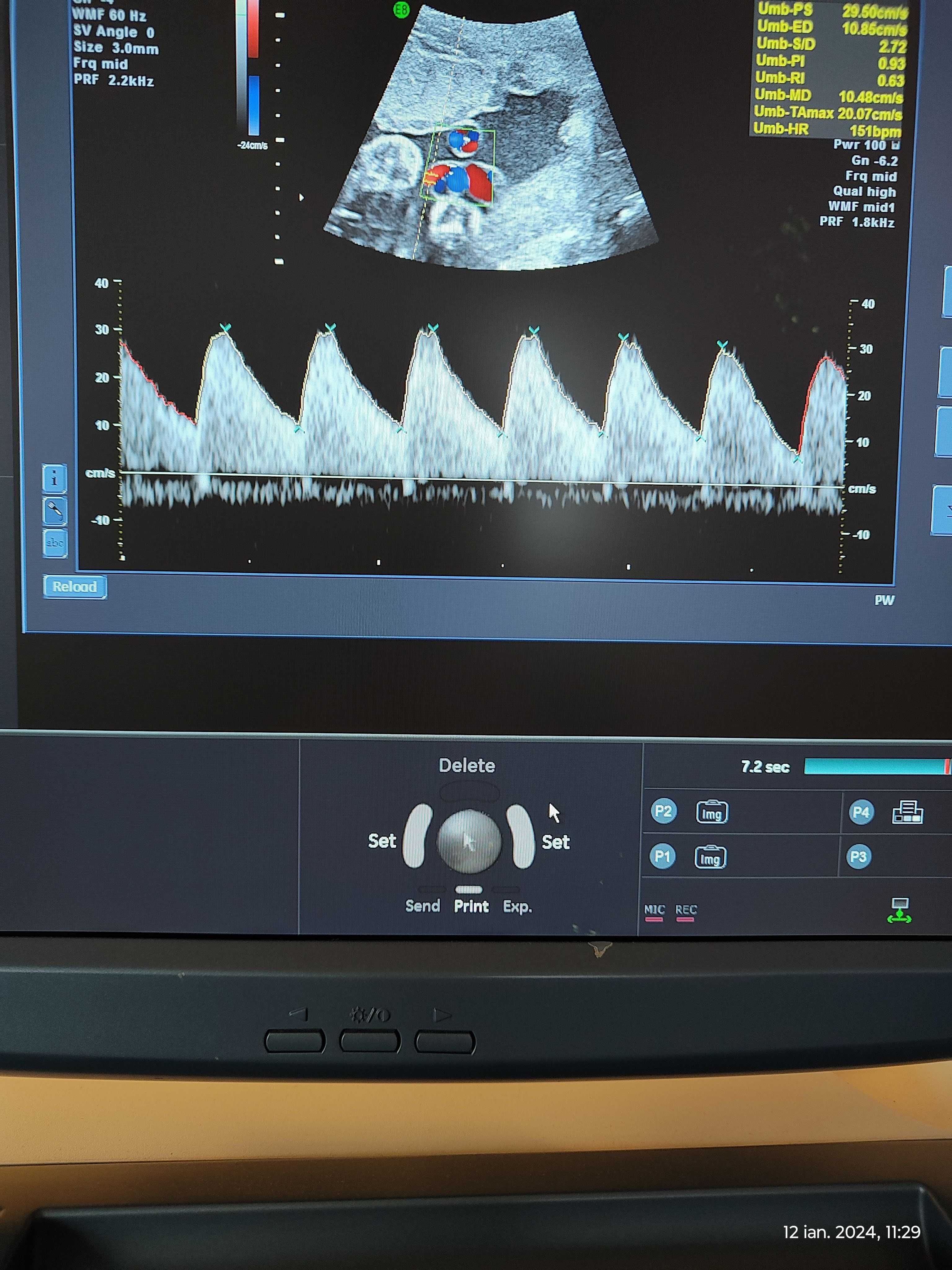 Ecograf doppler Voluson E8 Expert