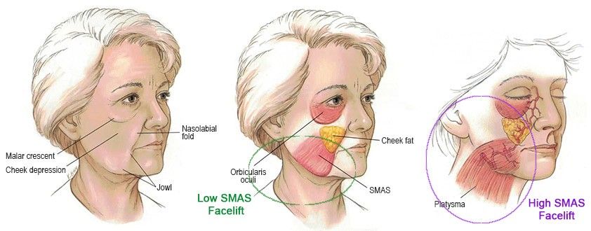 SMAS лифтинг. Безоперационная подтяжка лица. Ультразвуковой лифтинг.