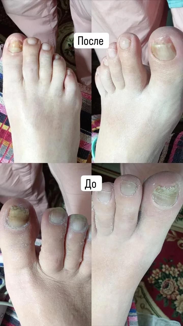 Педикюр  сложный педикюр