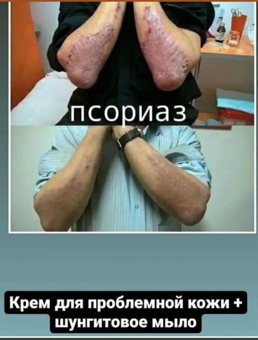 Шунгитовое мыло двух видов на страже вашего здоровья.