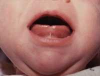 Подрезание уздечки под языком у новорожденных.
