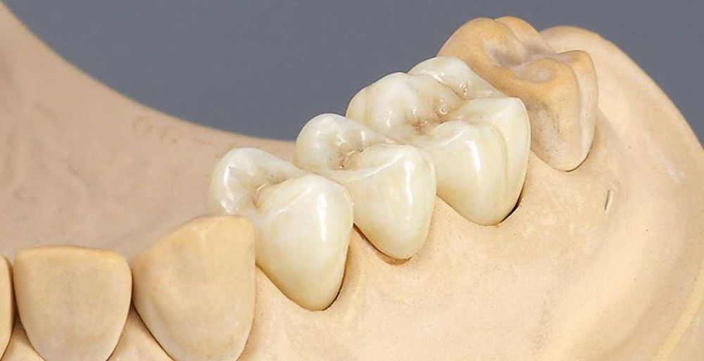 Фрезерный Центр Лаборатория Зуботехническая CAD/CAM коронки из циркон