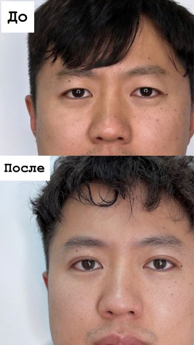 НИТЕВАЯ блефаропластика сангапруи