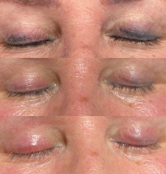 Удаление тату и татуаж